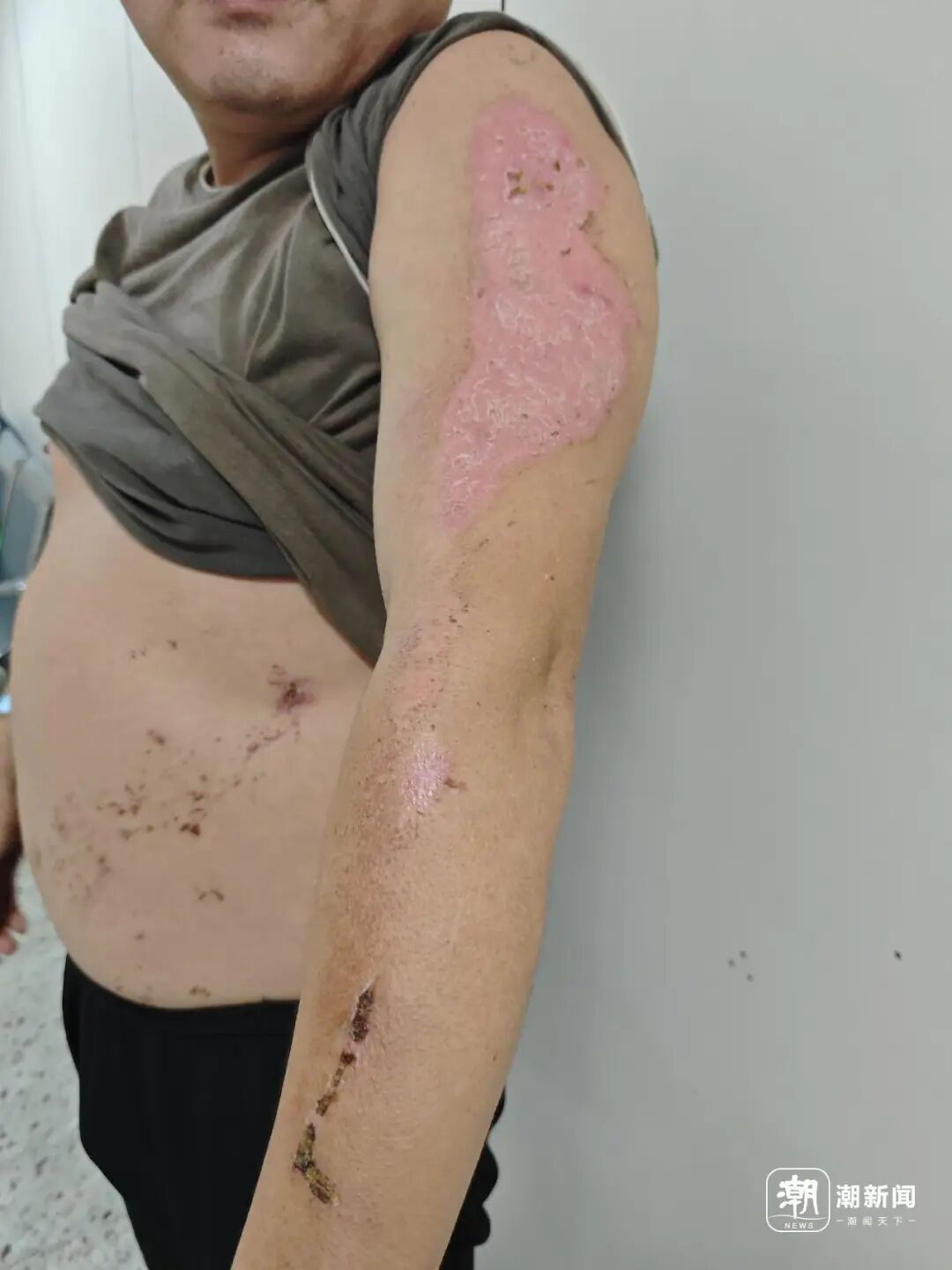丈夫两次冲进火场救妻双双烧伤丈夫两次冲进火场救妻双双烧伤，英勇背后的故事